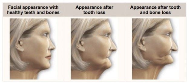 healthy teeth and bone graphic