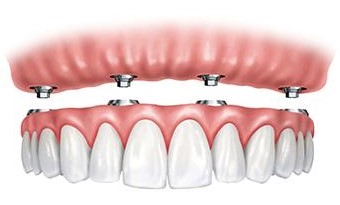 Graphic of implants on upper arch