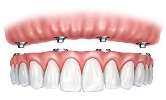 Graphic of implants on upper arch