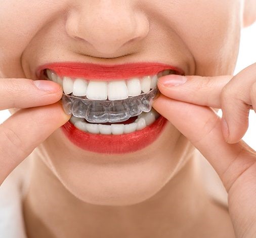 Woman inserting an invisalign arch
